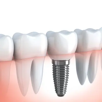 Implantes