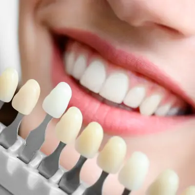 Lentes de Contato Dental