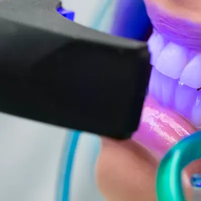 Clareamento Dentário