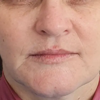 Reabilitação com Lentes de Contato e Implantes